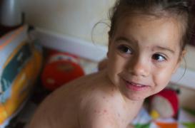 Varicelle : l'épidémie se poursuit dans 11 régions