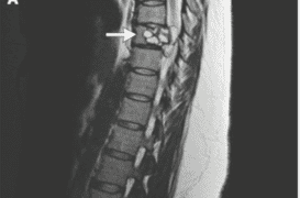 Hydatidose: elle vivait avec un ver dans les vertèbres et se paralysait