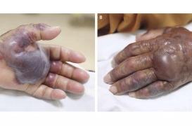 Corée du Sud : un homme amputé de la main après avoir mangé des fruits de mer crus