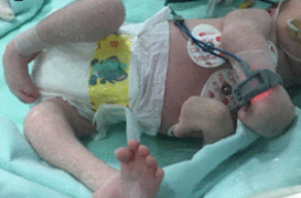 Zika : le virus provoquerait des malformations articulaires chez les bébés 