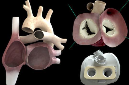 Coeur Carmat : 1ères données cliniques sur les implantations et les décès