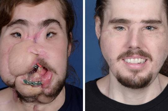 Un Américain subit une greffe faciale après une violente tentative de suicide