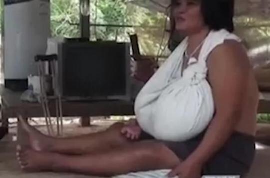 Hypertrophie mammaire : la poitrine de cette femme grossit à vue d’œil depuis 9 mois