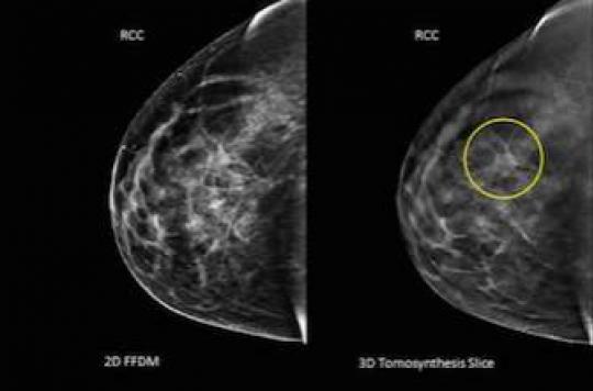 Cancer du sein : la chirurgie conservatrice expose à une récidive dans 1 cas sur 4