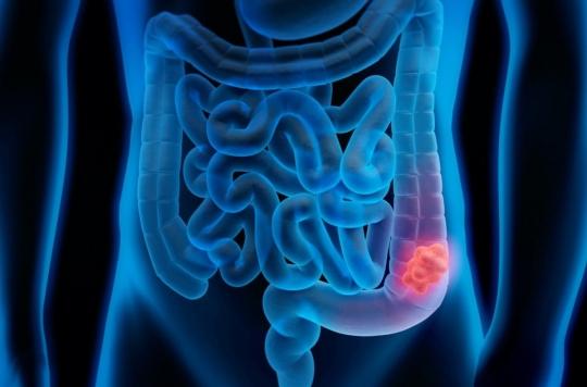 Cancer colorectal : après un autotest positif, une coloscopie trop tardive augmente le risque de découvrir des lésions cancéreuses 