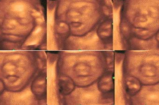 Les Echographies De Convenance Remises En Cause