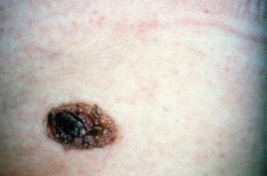Le nombre des cancers de la peau explose au Royaume-Uni