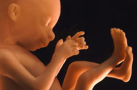 Fœtus fossilisé : 300 cas recensés dans le monde