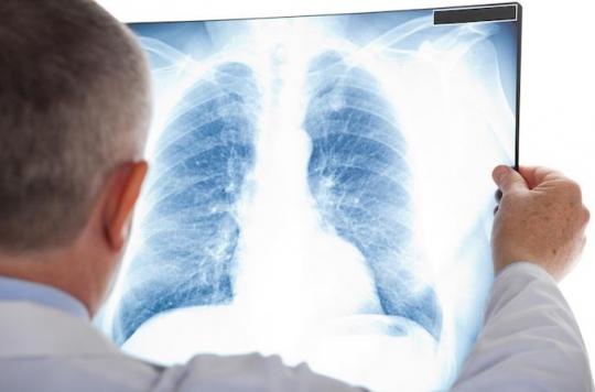 Cancer du poumon : un accès réduit au traitement combiné réduit l’espérance de vie