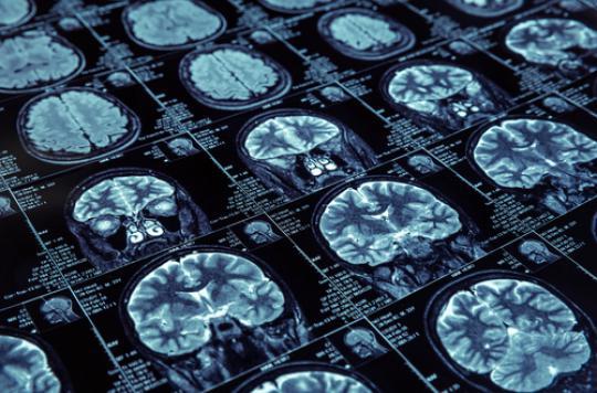 Alzheimer : des fuites répérées dans le cerveau