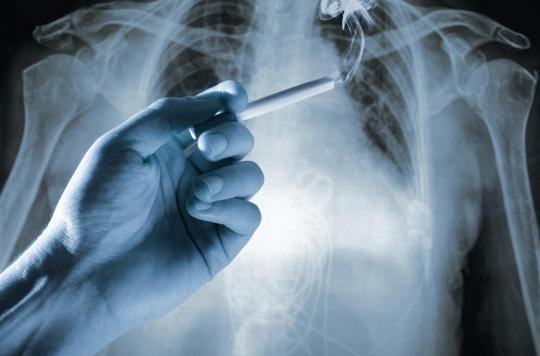 Dépistage du cancer du poumon : les États-Unis avancent l’âge à 50 ans