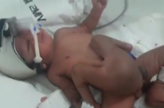 Inde : un bébé naît avec 4 jambes