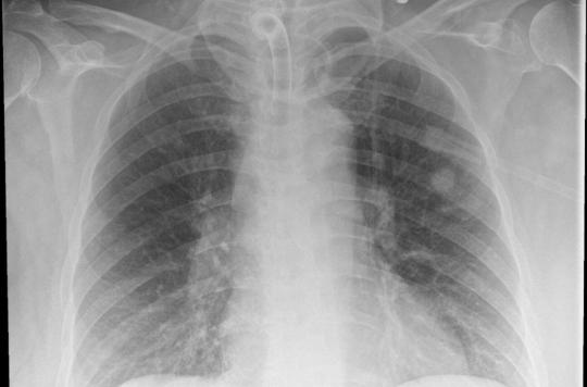 Une femme se retrouve avec un écouvillon coincé dans un poumon après un test Covid-19