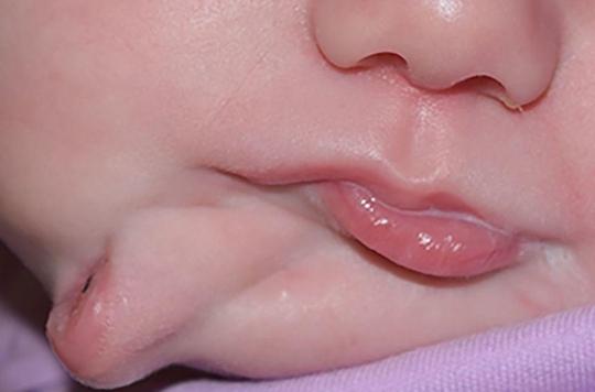 Diprosopie : un bébé naît avec deux bouches et deux langues