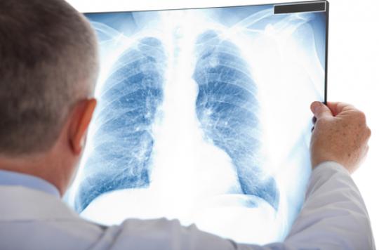 Cancer du poumon : une application améliore le suivi des malades