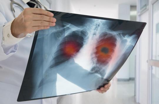 Cancer du poumon : la double greffe réussie est-elle toujours possible ?
