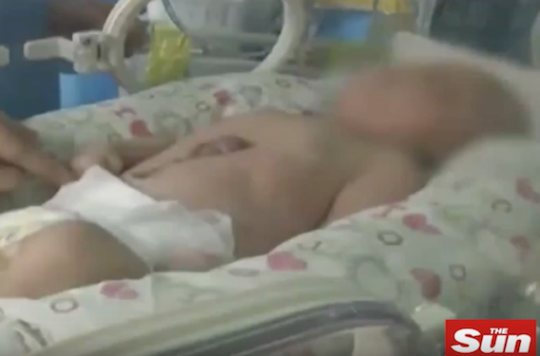 Chine Un Bebe Est Ne Avec Le Cœur Hors De La Poitrine