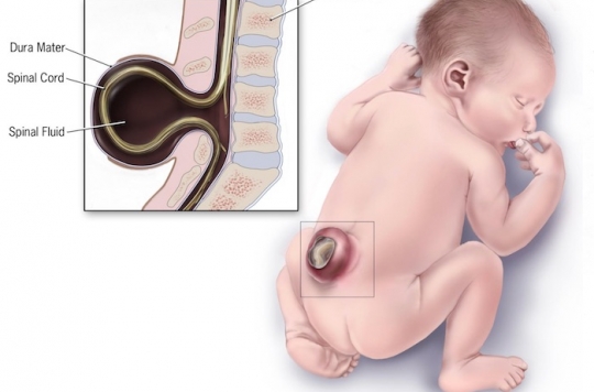 Spina Bifida Deux Bebes Operes Dans L Uterus Un Exploit Medical