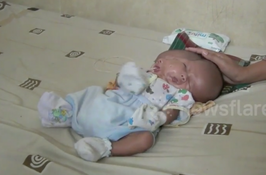 Indonésie : un bébé naît avec deux visages et deux cerveaux 