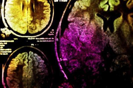 Anévrisme cérébral : des chercheurs découvrent un gène responsable