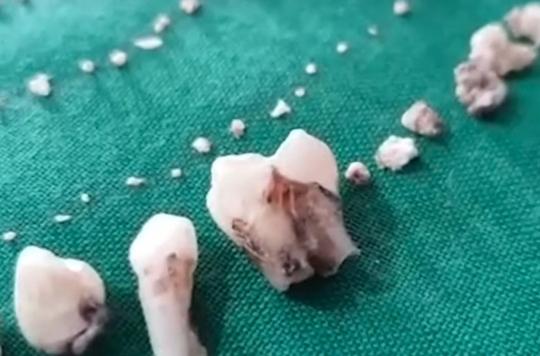 Inde : 526 dents trouvées dans la bouche d'un petit garçon de 7 ans 