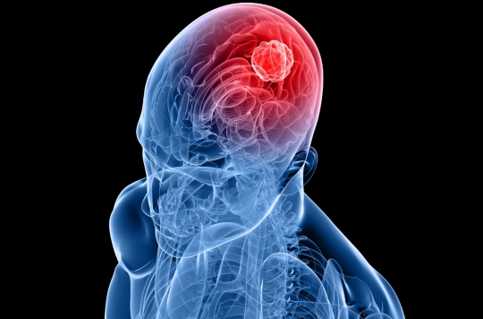 Cancer : le cerveau jouerait un rôle important dans le développement des tumeurs