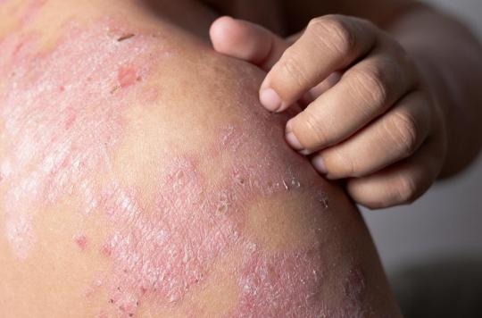 Why eczema may be associated with a higher risk of death