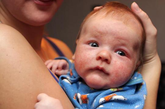 Eczema Du Nourrisson Les Antibiotiques Inutiles En Cas D Infection