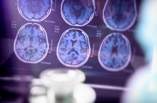 Alzheimer : une hyperactivation du cerveau est un signe précoce