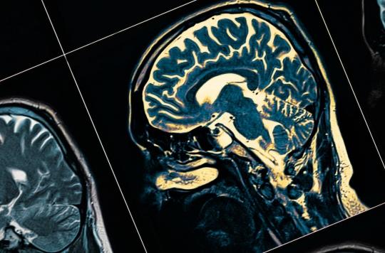 Schizophrénie : des rayons X pour analyser les neurones