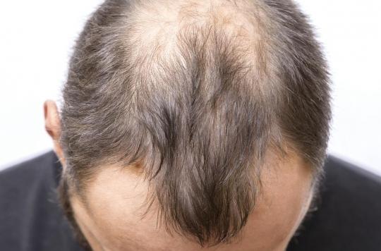 Comment le stress empêche les cheveux de pousser