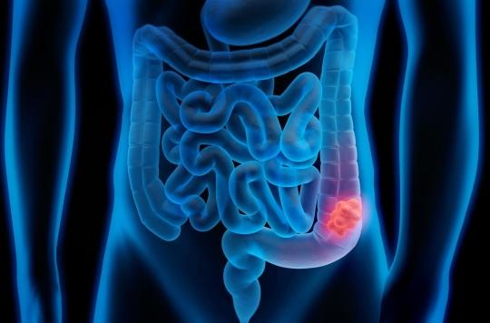 Cancer du colon : symptômes et dépistage