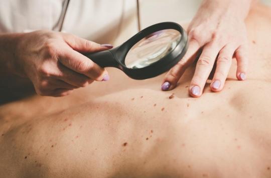 Comment détecter un cancer de la peau ? 