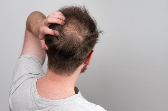 Perte de cheveux : et si une thérapie génique permettait de traiter l’alopécie ?