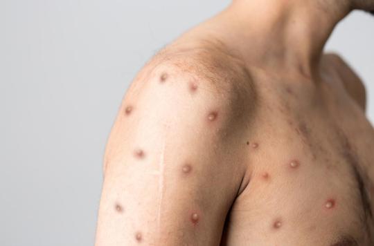 La variole du singe pourrait entraîner l'encéphalite, de la confusion ou des convulsions chez certains patients