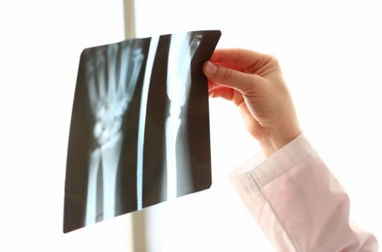 Fractures: having many in childhood increases the risk in adulthood