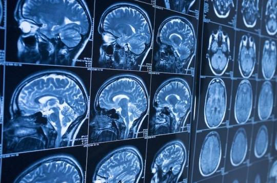 Etats-Unis : des chercheurs ont étudié 128 parties du cerveau pour comprendre le vieillissement