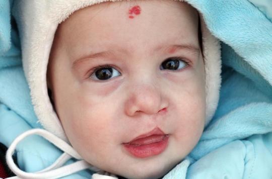 Decoder La Genetique Du Visage Pour Reparer Le Bec De Lievre