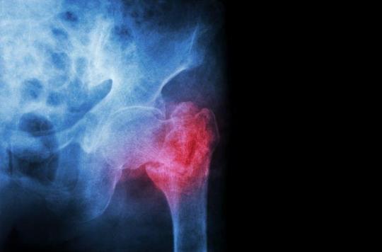 Ostéoporose : les traitements sont-ils mauvais pour les dents ?