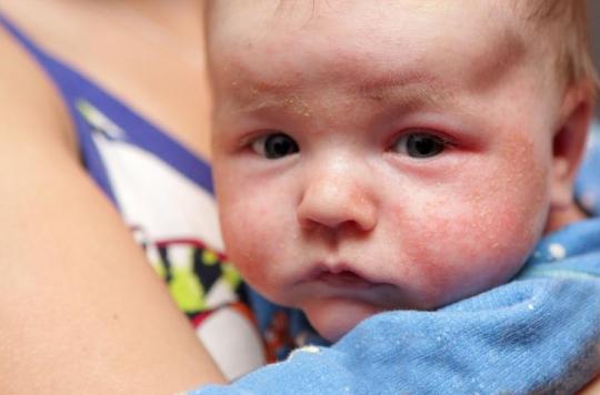 Dermatite Atopique Epidemie D Eczema Chez Les Enfants Des Villes Et Cela Augmente Encore