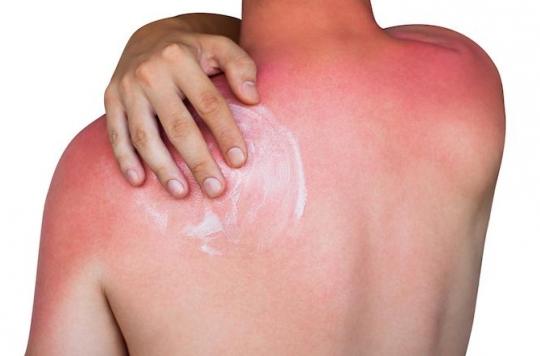 Coups de soleil : 10 gènes font la différence entre bronzage et brûlure de la peau