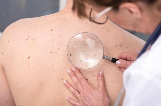 Cancer de la peau : un dépistage gratuit sera organisé du 20 au 24 mai