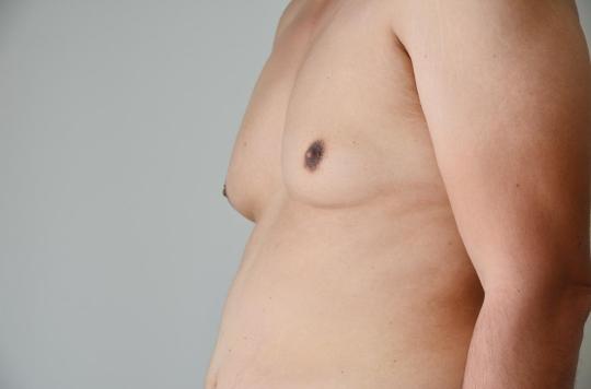 Gynecomastia: what is this disease from which singer Slimane suffered?