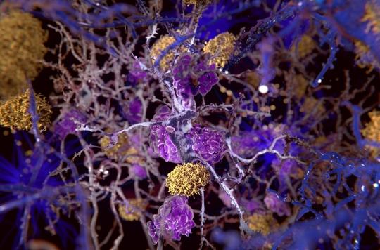 Alzheimer : la baisse du débit sanguin dans le cerveau pourrait (enfin) expliquer la maladie