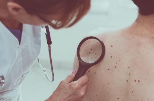 Cancer de la peau : combiner génétique et exposition au soleil pour évaluer les risques 
