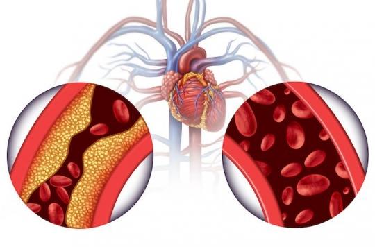 Hypertension artérielle : seulement moins d'un malade sur 2 est ...