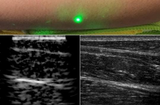 La première échographie laser réalisée à distance grâce aux ultrasons