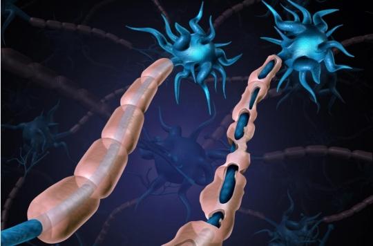 Sclérose en plaques : qu’est-ce que le traitement par cellules souches ?