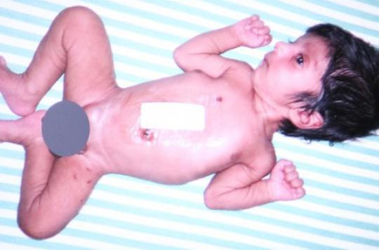 Inde Le Bebe Ne Avec 4 Jambes Opere Avec Succes
