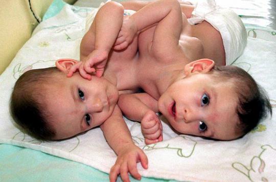 Suisse Des Sœurs Siamoises Operees Avec Succes